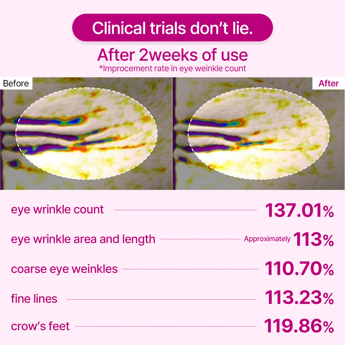 Calcium Volume Eye Patch — eye wrinkle results after two weeks