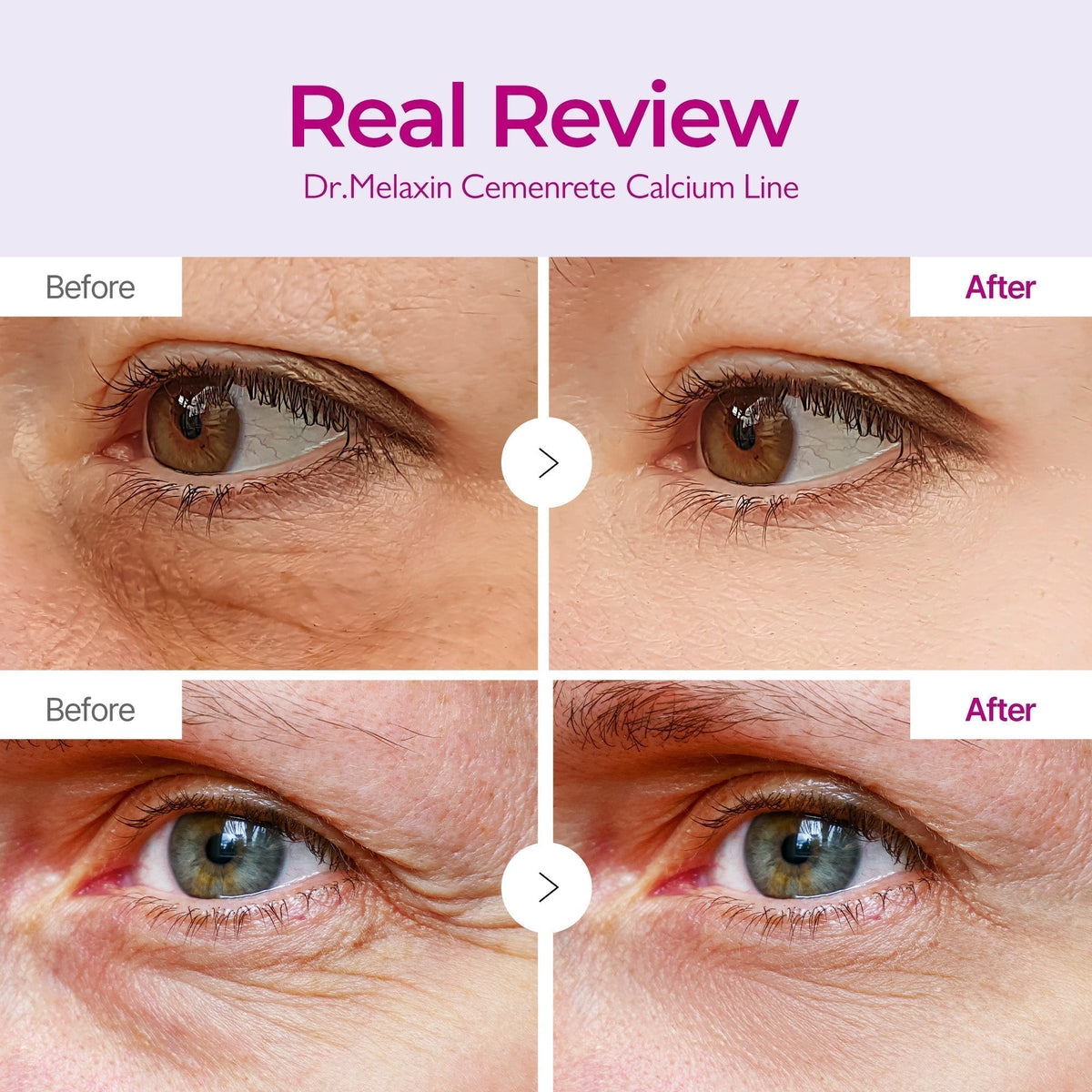 Cemenrete Calcium eye patch real review before and after